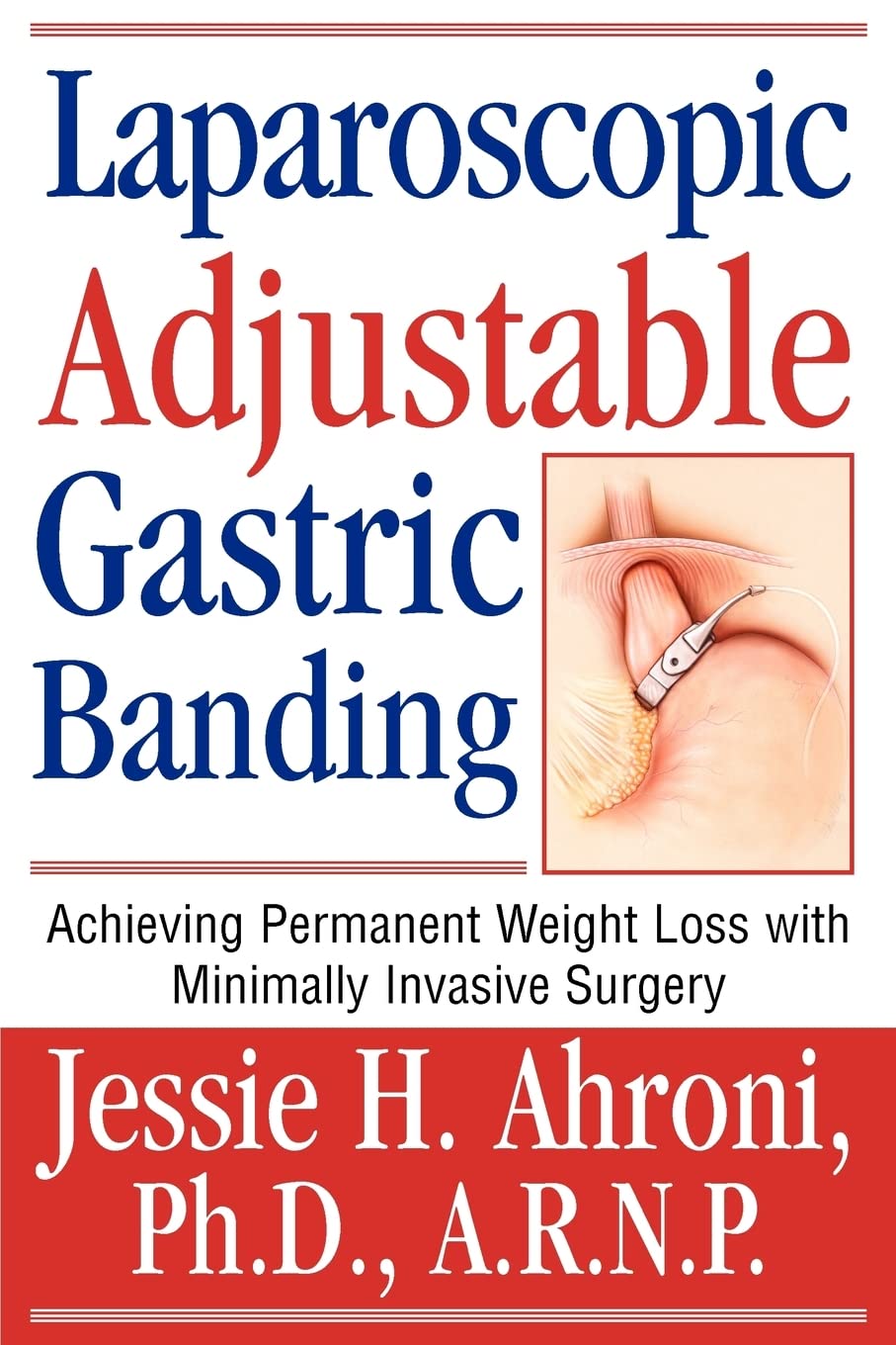 Laparoscopic Adjustable Gastric Banding: Achieving Permanent Weight Loss with Minimally Invasive Surgery